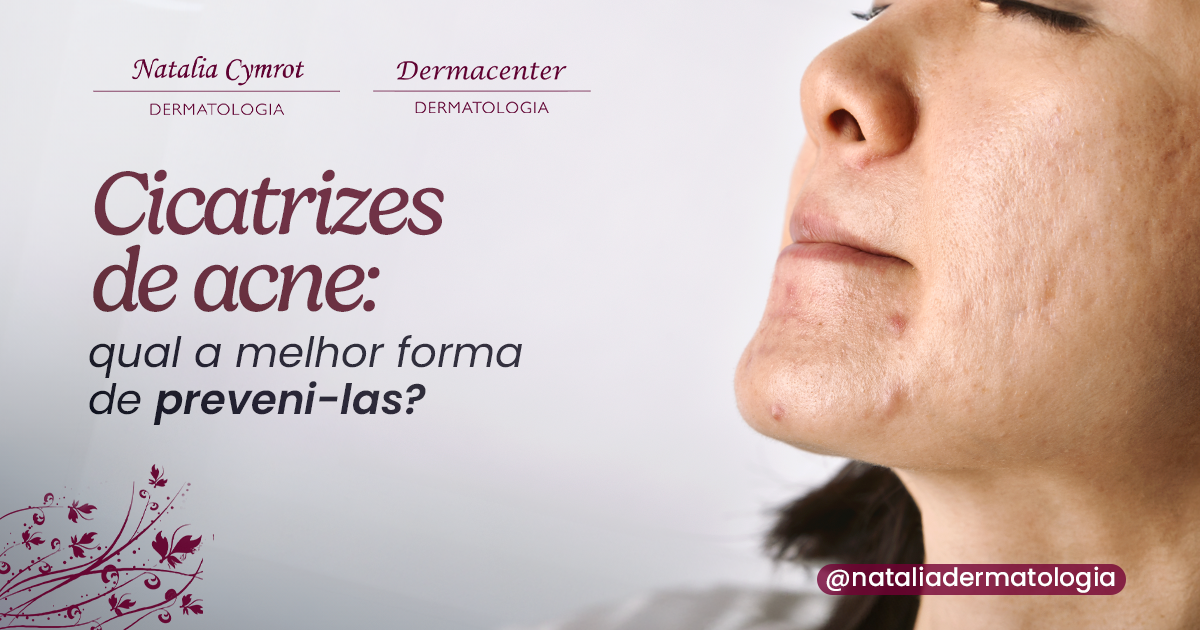 Cicatrizes de acne qual a melhor forma de preveni las Clínica