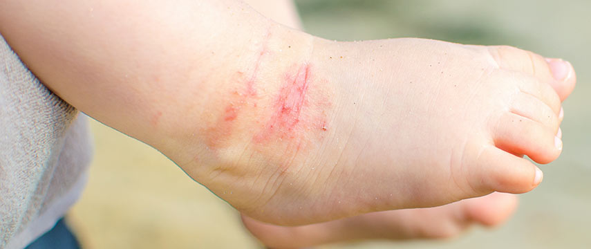 Tratamento de Dermatite Atópica ou Eczema Atópico