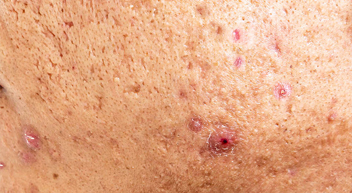 Dermatologia Estética e Lasers Cicatrizes de acne - imagem ilustrativa
