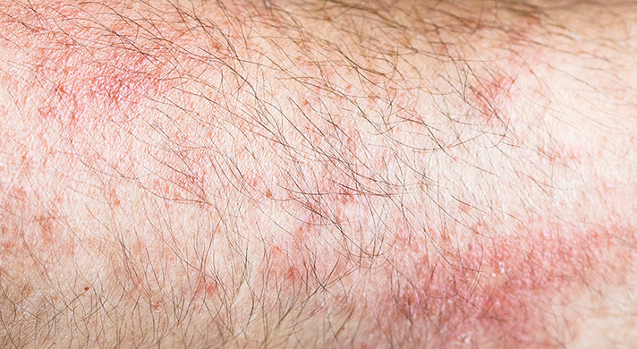 Dermatite Atópica - imagem ilustrativa