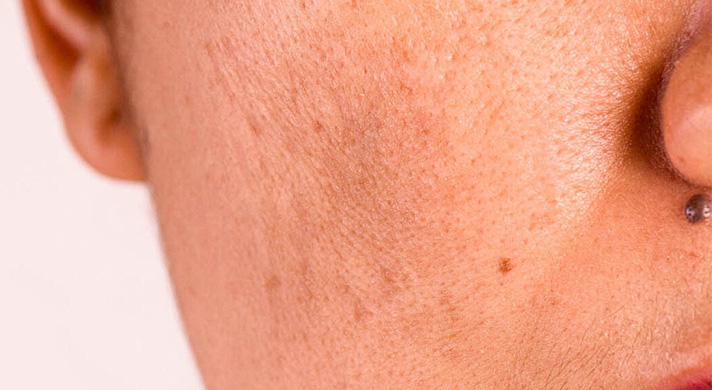 Dermatologia Estética e Lasers - Manchas na pele - imagem ilustrativa