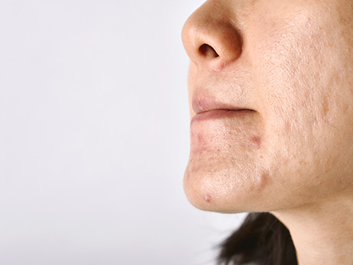 A imagem mostra uma mulher de cabelo preto com os olhos fechados, comprimindo os lábios. O rosto da mulher possui algumas acnes e cicatrizes de acne.