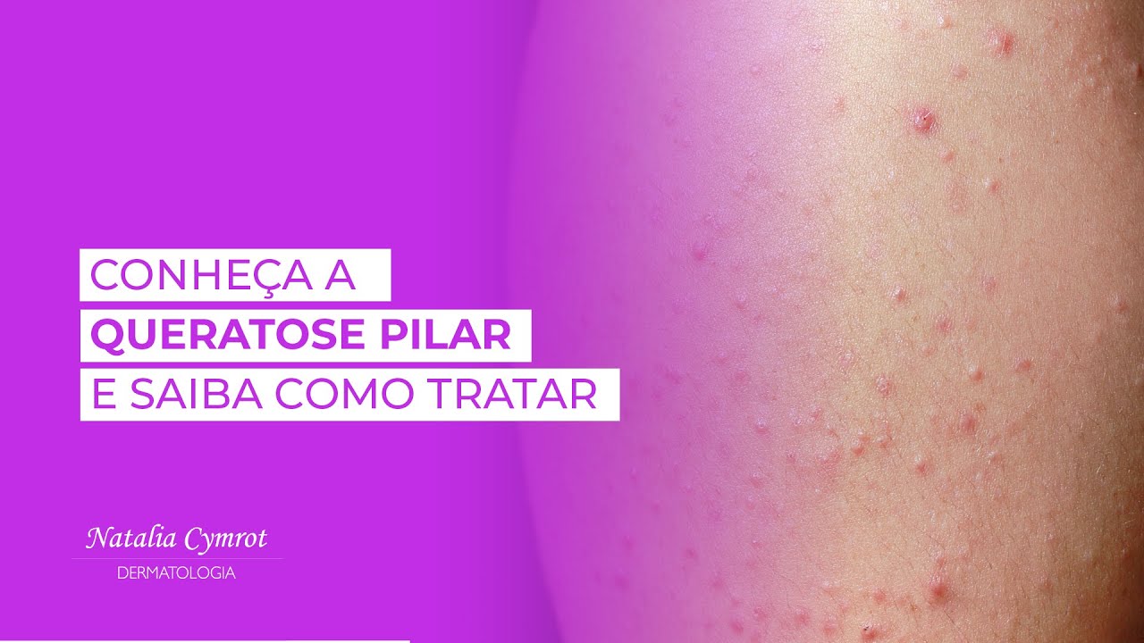 A imagem é de uma queratose pilar está ao lado do titulo do video