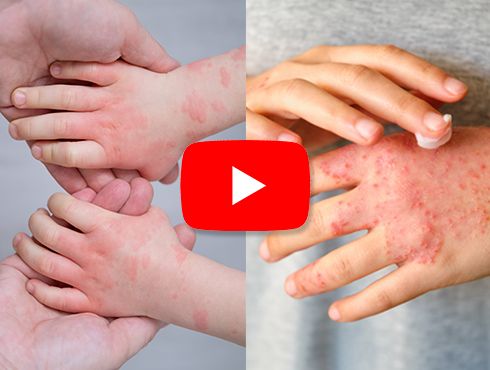 Imagem ilustra a mão de uma mulher e de uma criança, sendo afetada pela dermatite, há algumas bolhas vermelhas nas mãos de ambos.