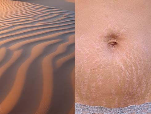A imagem mostra duas imagens, do lado direito uma barriga com estrias e ao lado esquerdo uma região de areia onduladas
