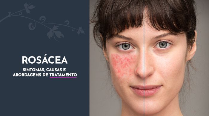 A imagem mostra o rosto de uma mulher, em que metade do rosto está normal e a outra está com uma manchas vermelhas como acne