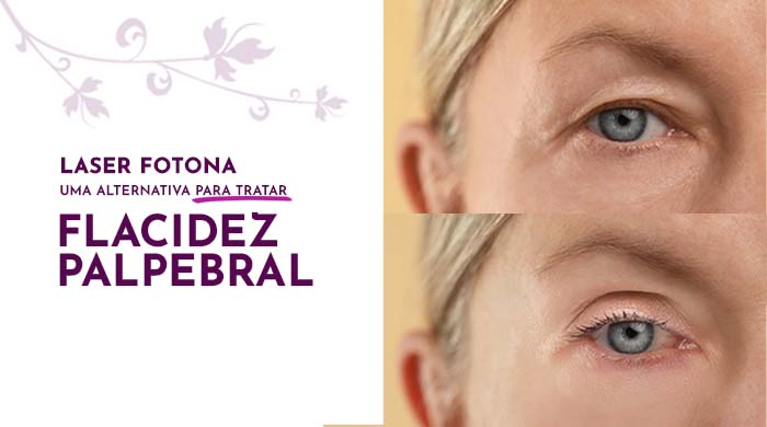 laser fotona uma alternativa para tratar flacidez palpebral blog