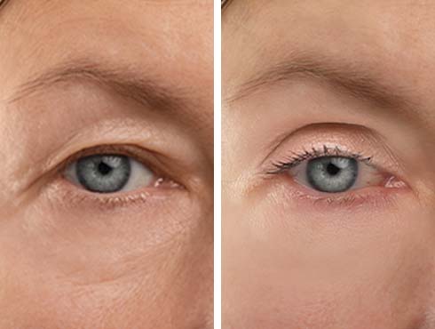 A imagem mostra um comparativo de olhos antes e depois de um tratamento estético. O olho à esquerda apresenta pele com flacidez, enquanto o olho à direita está visivelmente mais firme e rejuvenescido.
