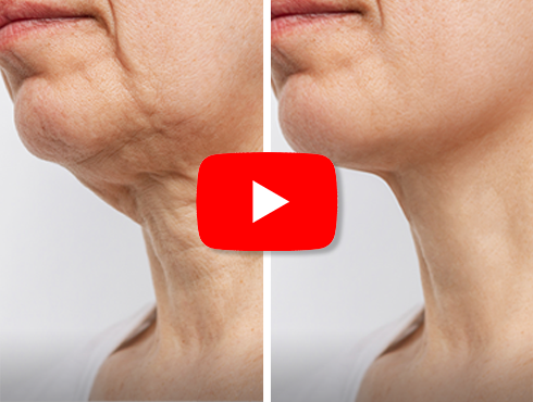Imagem comparando o pescoço de uma pessoa mais velha antes e depois de um tratamento, mostrando uma redução significativa de rugas e flacidez.