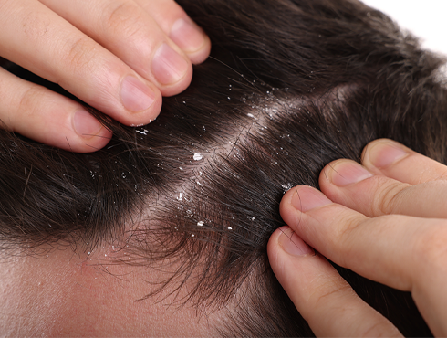 Close-up do couro cabeludo com descamação visível, indicando presença de caspa. As mãos afastam o cabelo para mostrar melhor a condição do couro cabeludo.