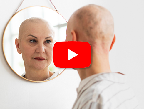 Mulher careca olhando para o espelho, aparentando serenidade e aceitação, com o ícone do YouTube sobreposto, indicando vídeo sobre queda de cabelo pós-quimioterapia.