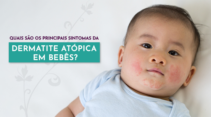 
Bebê com manchas vermelhas nas bochechas, sugerindo sinais de dermatite ou alergia na pele, deitado sobre uma superfície branca, com expressão tranquila.