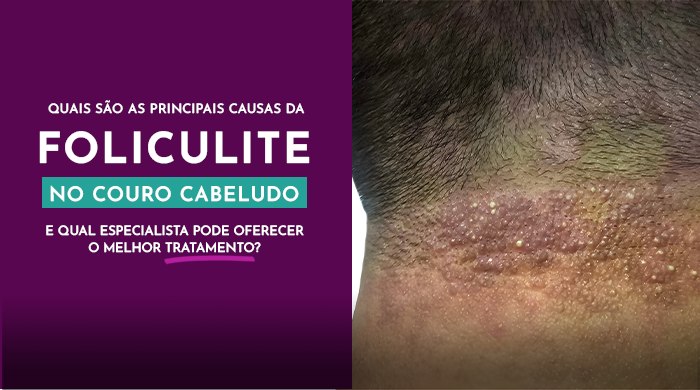 Close-up de uma área de pele escura e áspera na parte de trás do pescoço, apresentando sinais de hiperpigmentação e pequenas bolinhas, indicativos de uma possível condição dermatológica.