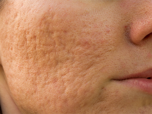 Close-up de pele com cicatrizes de acne, evidenciando textura irregular e poros dilatados na região da bochecha.