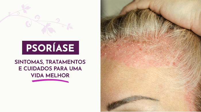 Pessoa com couro cabeludo irritado e descamado, evidenciando sintomas de uma condição dermatológica, com foco na região próxima à testa.