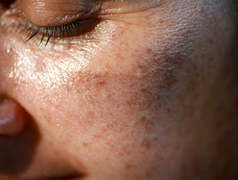 Close-up de pele feminina com melasma, mostrando manchas escuras na bochecha e textura brilhante sob luz intensa. Olho parcialmente fechado à esquerda.