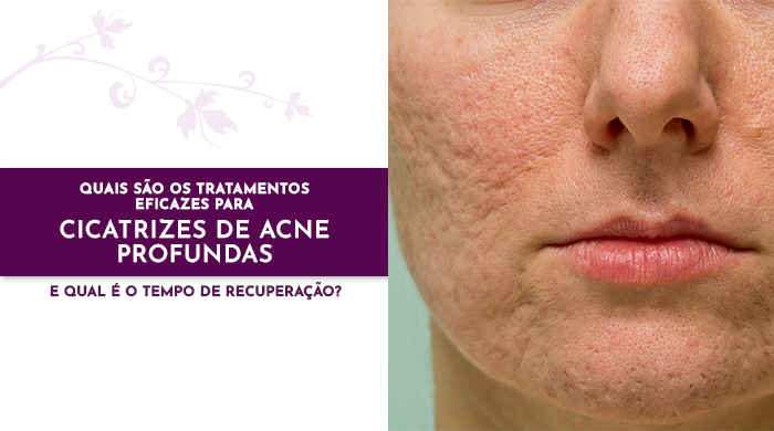 Rosto de uma pessoa com cicatrizes profundas de acne, destacando a textura irregular da pele.