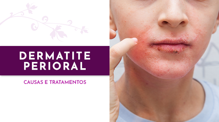 Criança com dermatite perioral, apresentando vermelhidão e irritação ao redor da boca, coçando a pele com os dedos. Fundo neutro e iluminado.