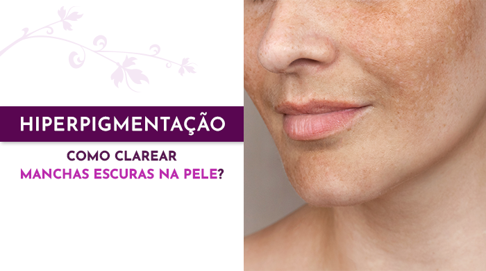 Rosto de uma mulher com melasma, apresentando manchas escuras irregulares na pele, especialmente nas bochechas e ao redor da boca.