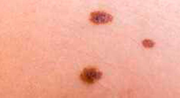 dermatologista câncer de pele