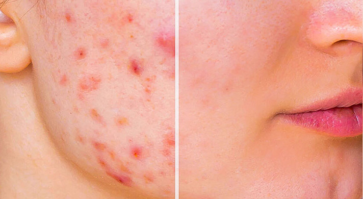 tratamento acne