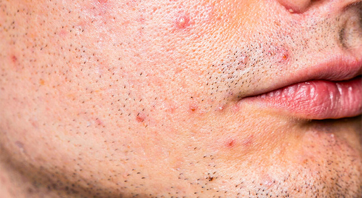 Tratamento Médico para Acne e Espinhas em São Paulo