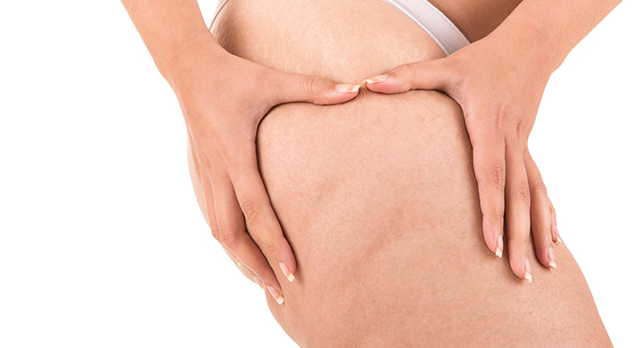 Tratamento para Celulite e Gordura Localizada em São Paulo