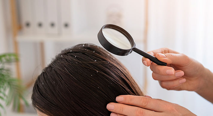 Tratamento para dermatite seborreica