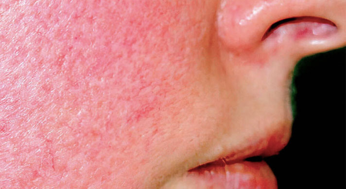 Dermatologista para rosácea em São Paulo.