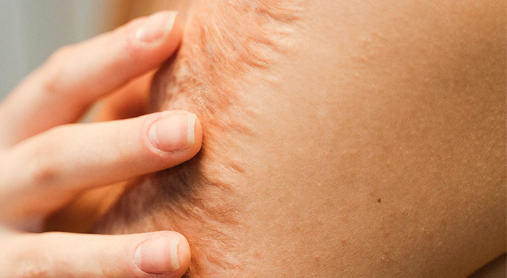 Dermatologista para Cicatriz em São Paulo