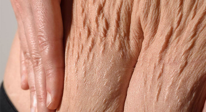 Tratamento para flacidez em São Paulo