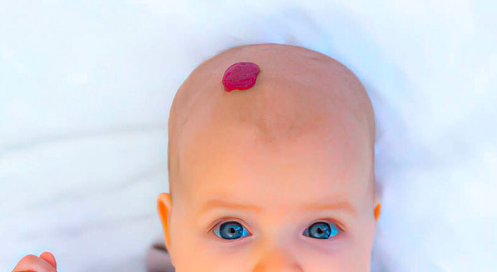 Dermatologista para Hemangioma em São Paulo