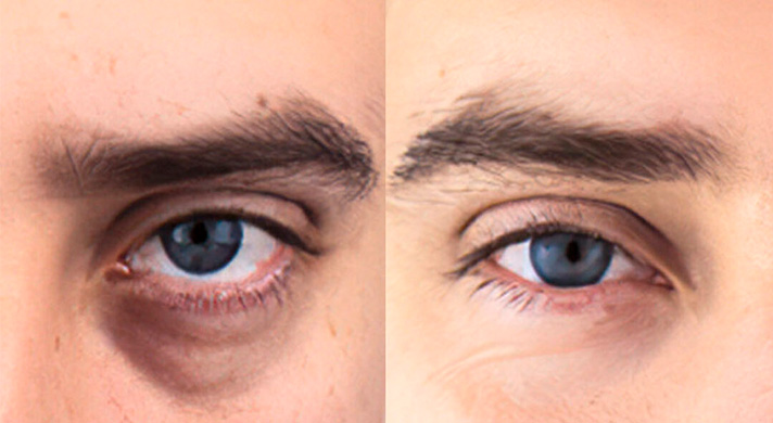 Tratamento para Olheiras em São Paulo