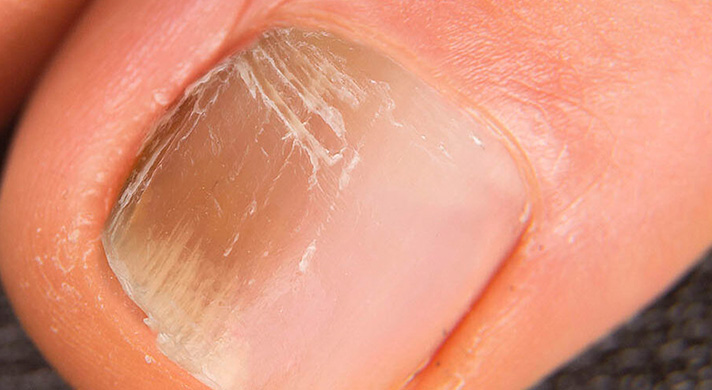 Tratamento para Micose de Unha em São Paulo