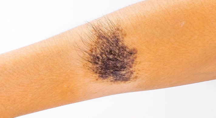 Dermatologista para Pintas de Nascença em São Paulo