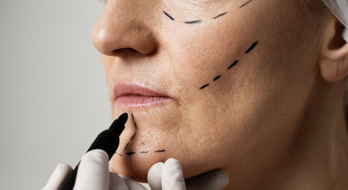 Preenchimento com Ácido Hialurônico em São Paulo