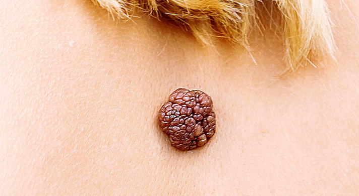 Remoção de Lesões Benignas da Pele em São Paulo