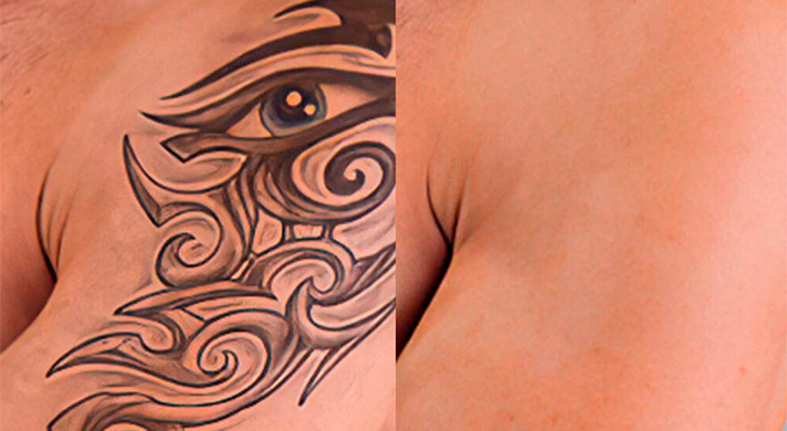 Remoção de Tatuagem a Laser em São Paulo