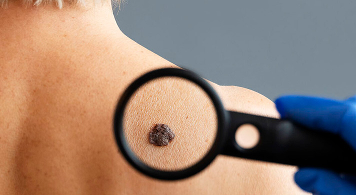 Especialista em Remoção de Pintas em São Paulo