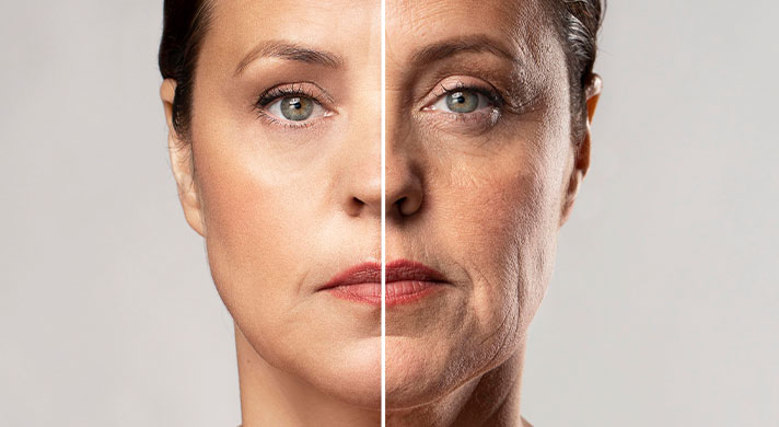 Tratamento para Rugas com Toxina Botulínica em São Paulo