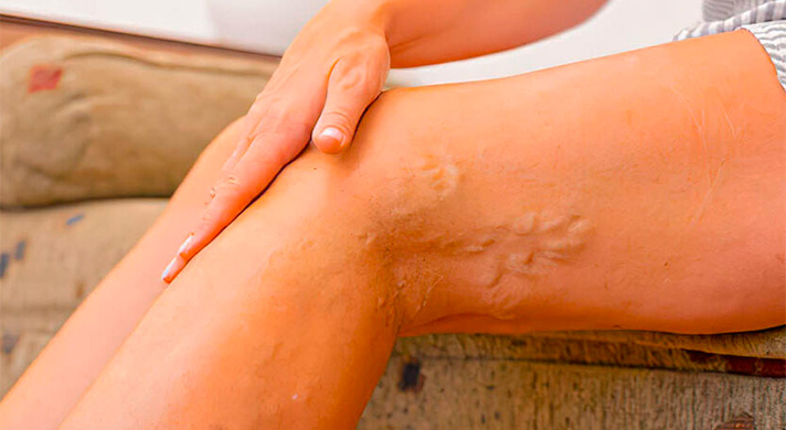 Tratamento de Varizes em São Paulo