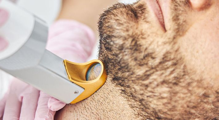 depilação definitiva masculina