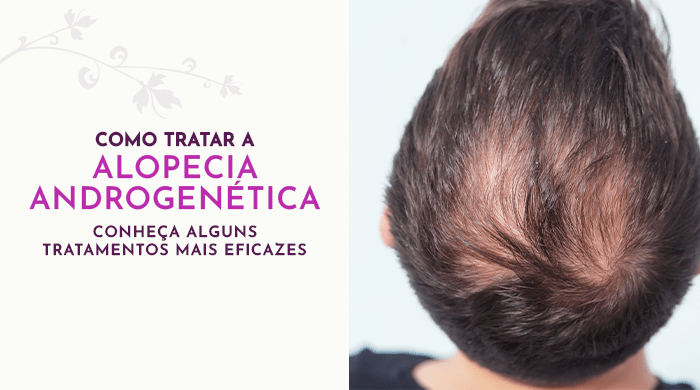 como-tratar-a-alopecia-androgenetica-conheca-alguns-tratamentos-mais-eficazes