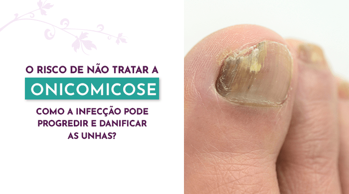 o-risco-de-nao-tratar-a-onicomicose-como-a-infeccao-pode-progredir-e-danificar-as-unhas